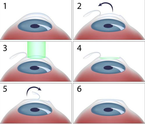 准分子飞秒icl近视手术怎么选专家适合的才是最好的